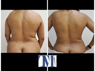 Liposuzione - Dr.ssa Truccolo Marialisa