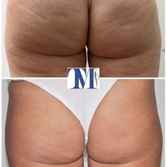 Liposuzione - Dr.ssa Truccolo Marialisa