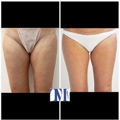 Liposuzione - Dr.ssa Truccolo Marialisa