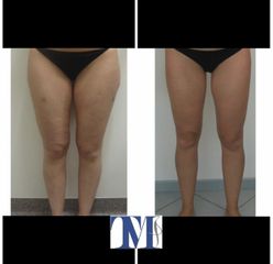 Liposuzione - Dr.ssa Truccolo Marialisa