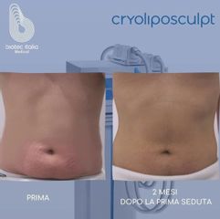 Criolipolisi - Dr.ssa Truccolo Marialisa