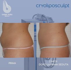 Criolipólisi - Dr.ssa Truccolo Marialisa