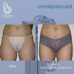 Criolipolisi - Dr.ssa Truccolo Marialisa