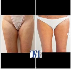 Liposuzione - Dr.ssa Truccolo Marialisa