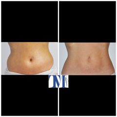 Liposuzione - Dr.ssa Truccolo Marialisa