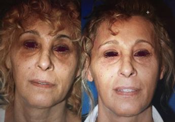 Eliminare occhiaie - Adriana Pozzi- Chirurgia Plastica E Ricostruttiva