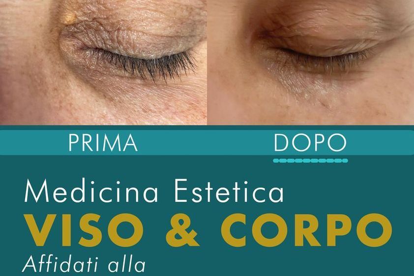 Xantelasmi prima e dopo - 850657