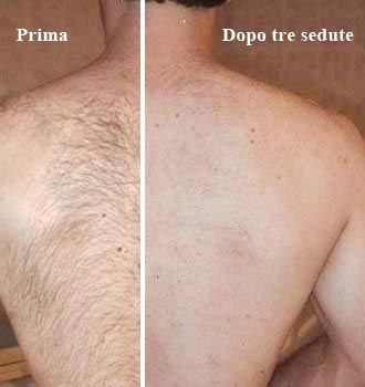 Depilazione a Luce Pulsata Prima e dopo - Guidaestetica.it