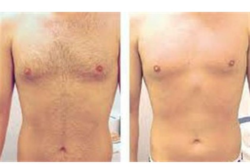 Depilazione a Luce Pulsata prima e dopo - 751551