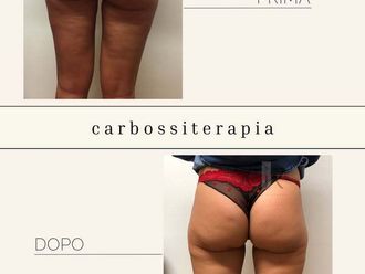 Carbossiterapia prima e dopo - 872730