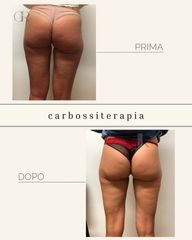 Dr Ristagno Carbossiterapia