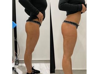 Gluteoplastica - Emsculpt - Dott. Marco Sonnino