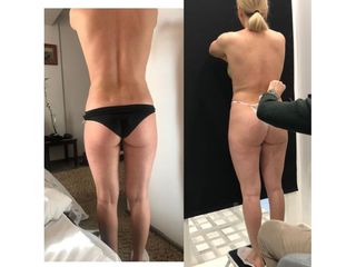 Liposuzione - Dott. Marco Sonnino