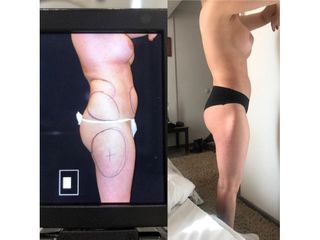 Liposuzione - Dott. Marco Sonnino