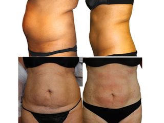Microlipocavitazione prima e dopo