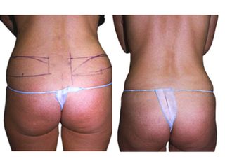 Microlipocavitazione prima e dopo