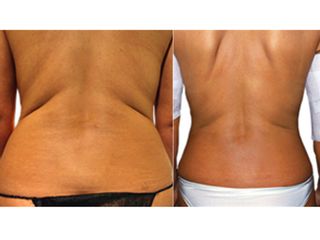 Microlipocavitazione prima e dopo