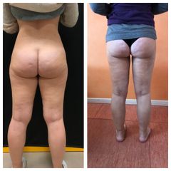 Cellulite - Dottoressa Anna Scevola