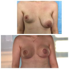 Lipofilling e mastopessi - Dottoressa Anna Scevola
