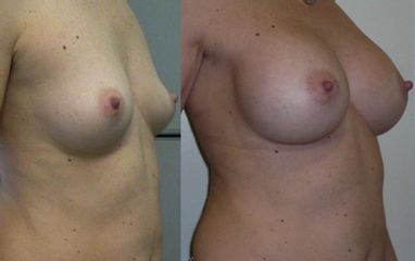 Mastoplastica additiva prima e dopo