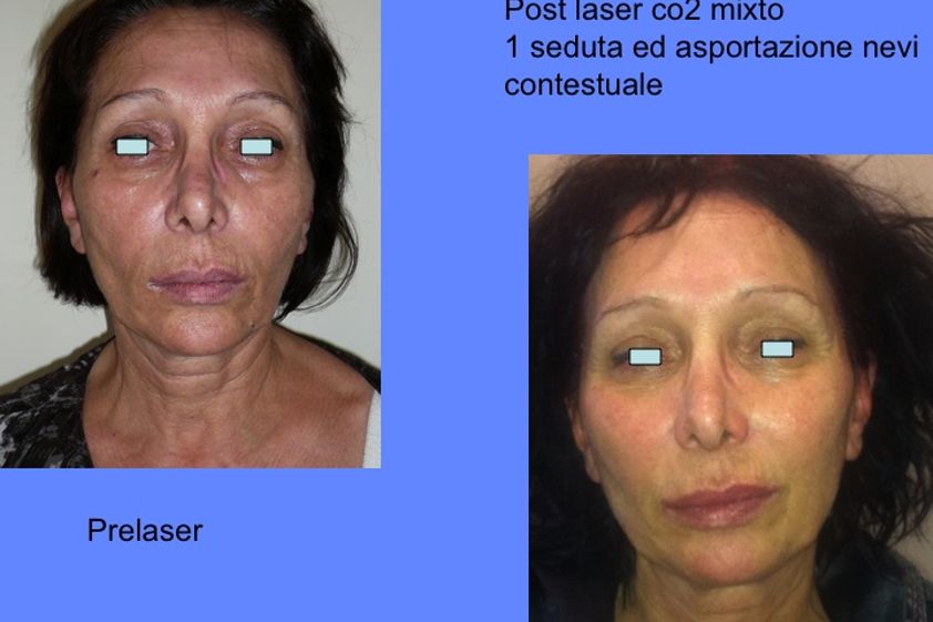 Laserterapia prima e dopo - 745019