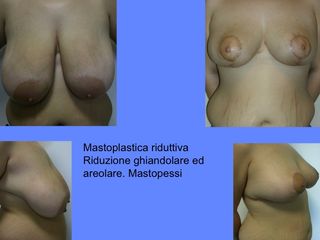 Mastoplastica riduttiva prima e dopo