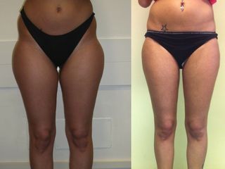 Microliposcultura prima e dopo