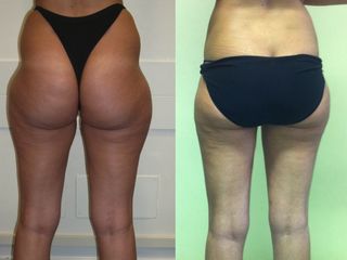 Liposcultura prima e dopo