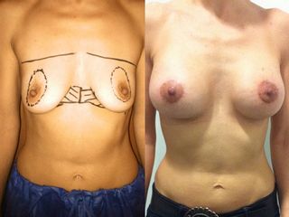 Seno svuotato post allattamento Mastopessi round block e protesi anatomiche