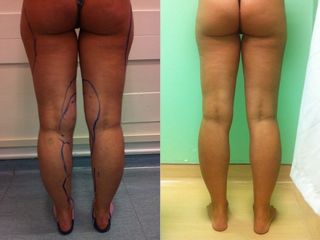 Liposuzione prima e dopo