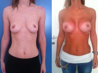 Pre & Post Mastoplastica Additiva