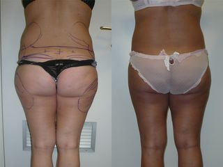 Gluteoplastica - Dott. Tommaso Savoia