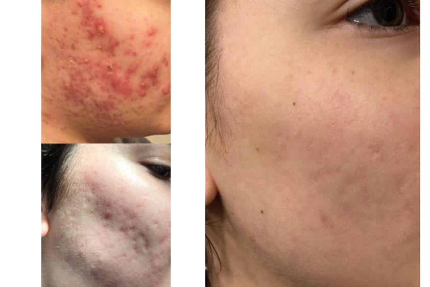 Acne prima e dopo - 772676