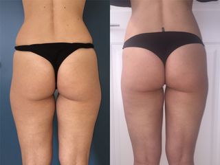 Gluteoplastica - Dott. Tommaso Savoia