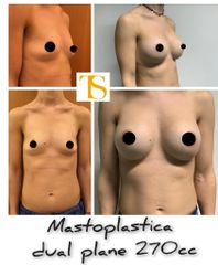 Mastoplastica additiva - Dott. Tommaso Savoia