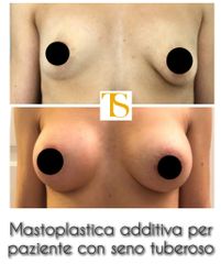 Mastoplastica additiva - Dott. Tommaso Savoia