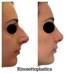 Rinosettoplastica - Dott. Tommaso Savoia