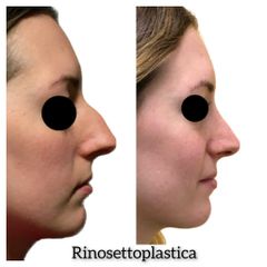 Rinosettoplastica - Dott. Tommaso Savoia