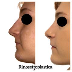 Rinosettoplastica - Dott. Tommaso Savoia