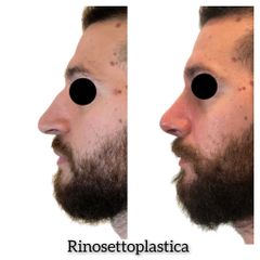 Rinosettoplastica - Dott. Tommaso Savoia