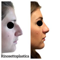 Rinosettoplastica - Dott. Tommaso Savoia