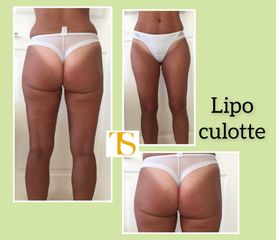 Liposuzione - Dott. Tommaso Savoia