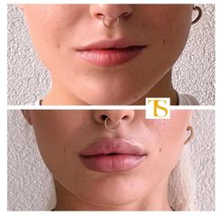 Filler labbra - Dott. Tommaso Savoia