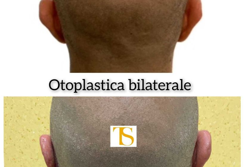 Otoplastica prima e dopo - 867193