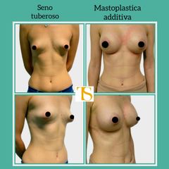 seno tuberoso Dr Savoia
