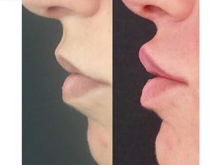 Labbra prima e dopo