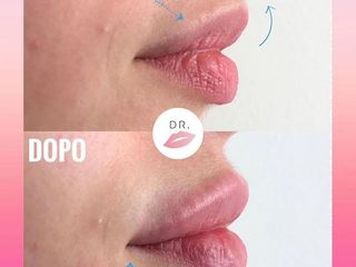 Lips Sculpture prima e dopo