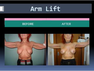 Lifting braccia - Dott. Hicham Mouallem