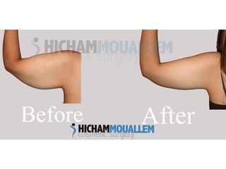 Lifting braccia - Dott. Hicham Mouallem
