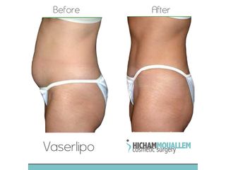 Liposuzione - Dott. Hicham Mouallem